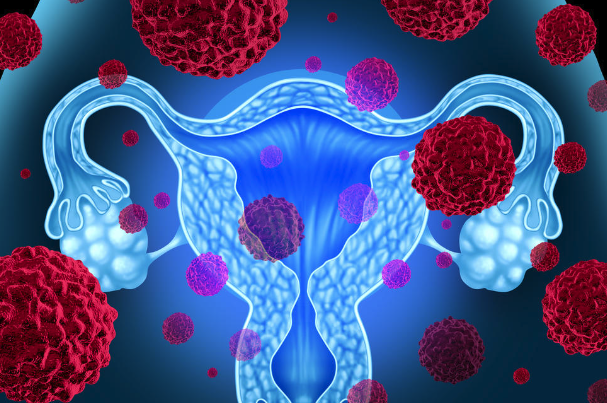 Primary HPV Testing in Cervical Cancer Screening—A Paradigm Shift (Part 3)